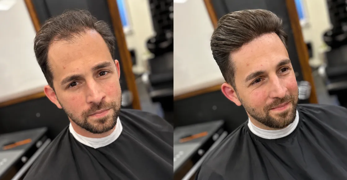 Before and after a Maverick Delta hair system fitting